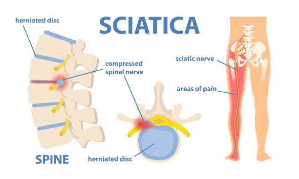 Spinal Decompression Therapy in [dm-citystate]
